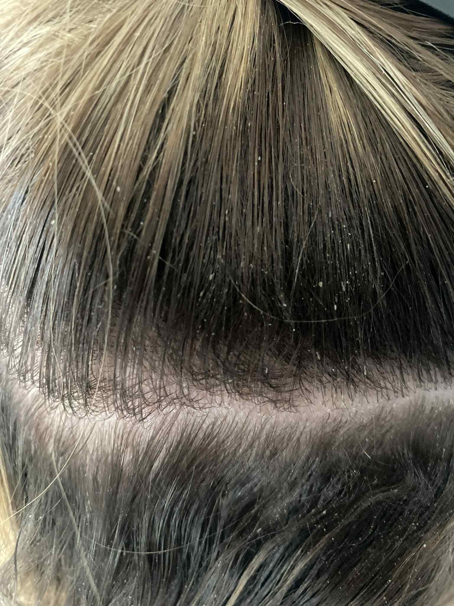 Close-up of hair with a focus on dandruff before and after