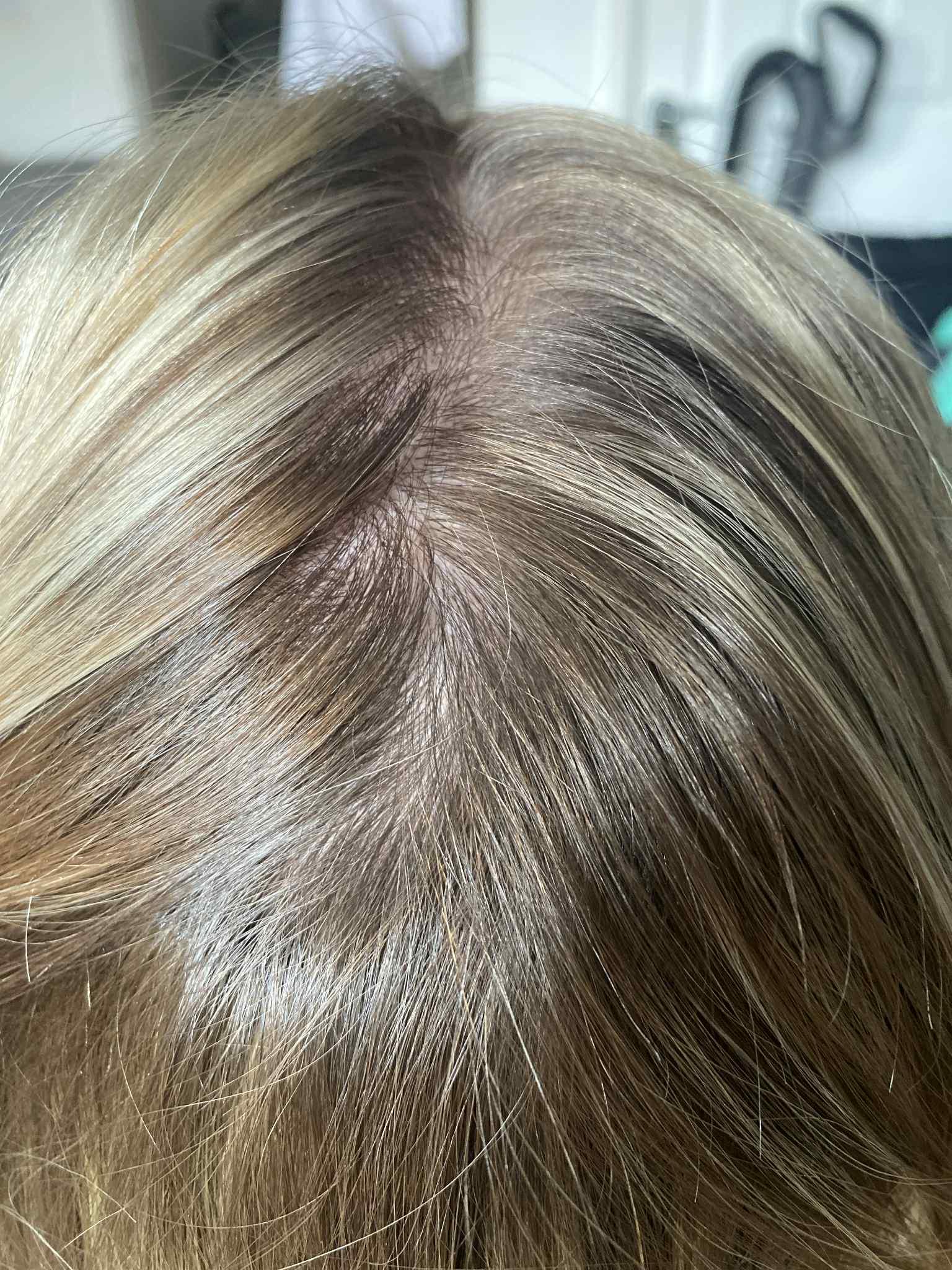 Close-up of hair with a focus on dandruff before and after