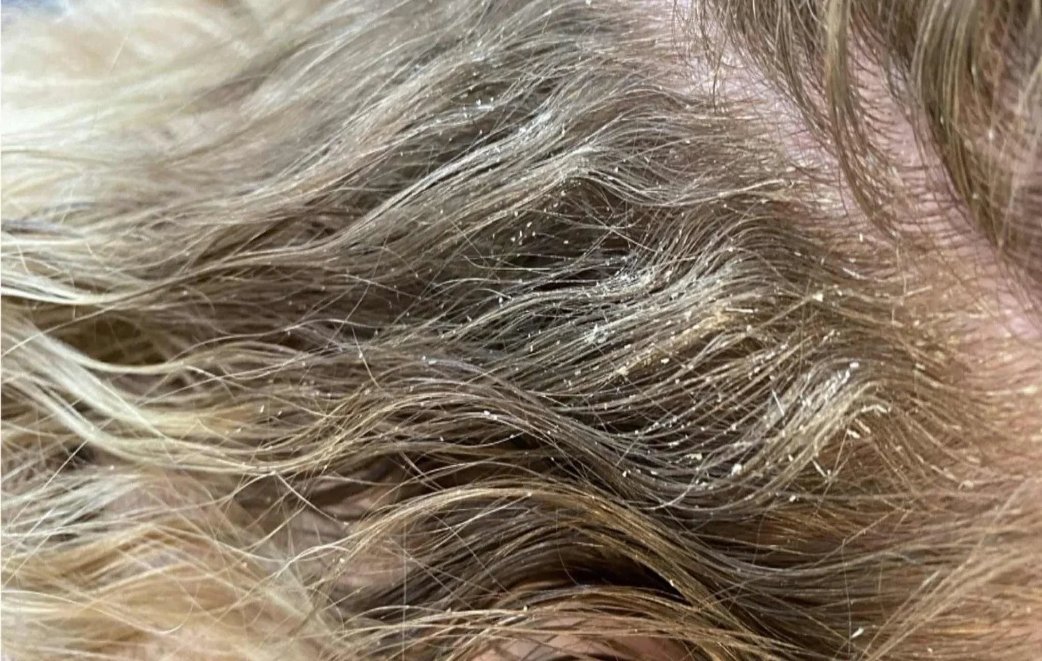 Close-up of blonde hair with visible dandruff