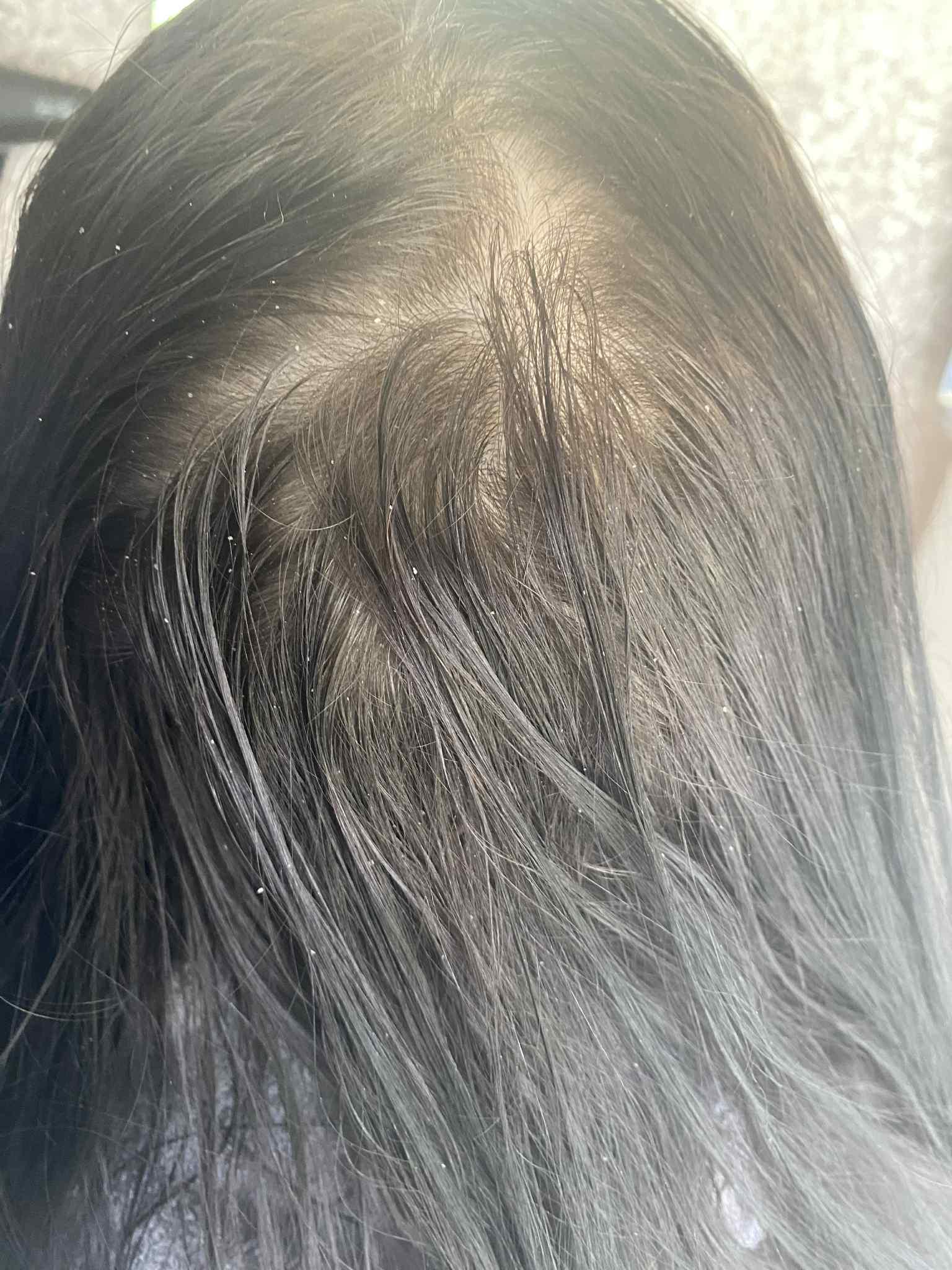 Close-up of hair with a focus on dandruff before and after